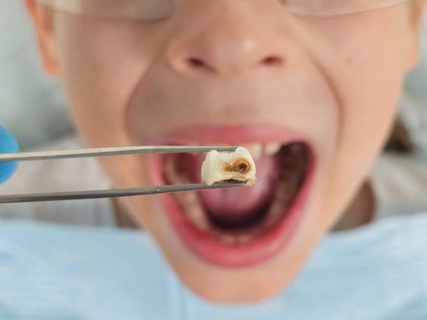 Best Emergency Dental Care for Abscessed Tooth in Michigan City, IN