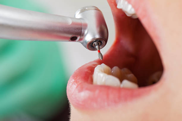 Best Emergency Dental Extractions in Michigan City, IN